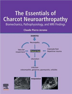 The Essentials of Charcot Neuroarthropathy：Biomechanics, Pathophysiology, and MRI Findings