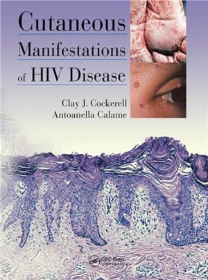 Cutaneous Manifestations of HIV Disease