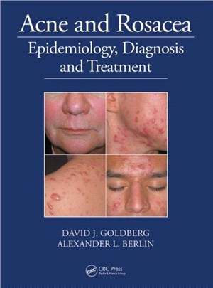 Acne and Rosacea：Epidemiology, Diagnosis and Treatment