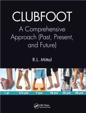 Clubfoot：A Comprehensive Approach (Past, Present, and Future)