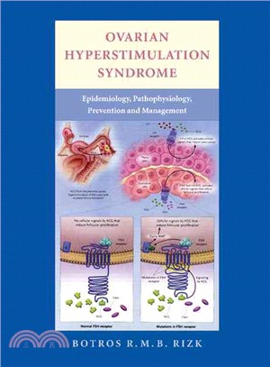 Ovarian Hyperstimulation Syndrome：Epidemiology, Pathophysiology, Prevention and Management