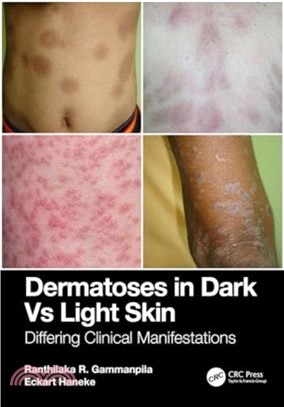 Dermatoses in Dark Vs Light Skin：Differing Clinical Manifestations