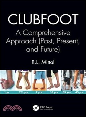 Clubfoot ― A Comprehensive Approach (Past, Present, and Future)