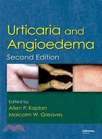 Urticaria and Angioedema