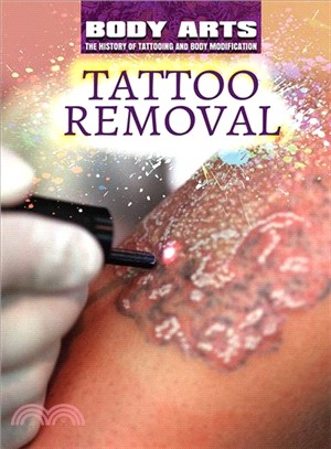 Tattoo Removal