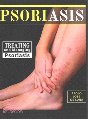 Psoriasis ― Treating and Managing Psoriasis