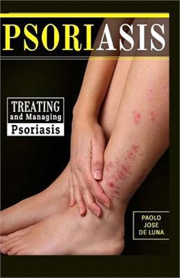 Psoriasis ― Treating and Managing Psoriasis