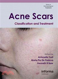 Acne Scars ─ Classification and Treatment