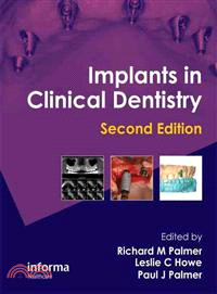 Implants in Clinical Dentistry