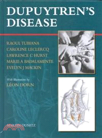 Dupuytren's Disease