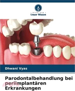Parodontalbehandlung bei periimplantären Erkrankungen