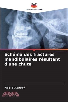 Schéma des fractures mandibulaires résultant d'une chute