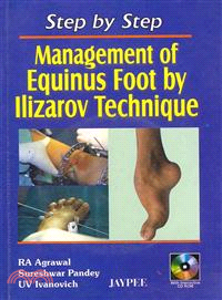 Management of Equinus Foot by Ilizarov Technique