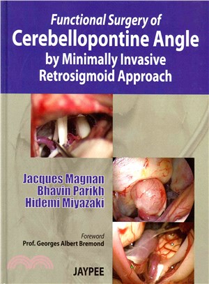 Functional Surgery of Cerebellopontine Angle by Minimally Invasive Retrosigmoid Approach