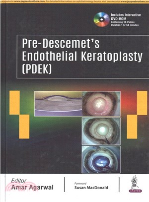 Pre-Descemet Endothelial Keratoplasty (PDEK)