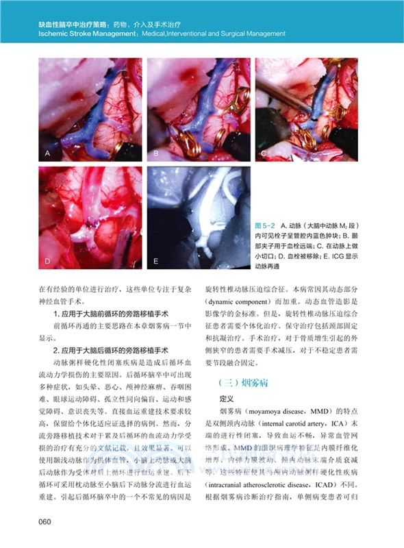 缺血性腦卒中治療策略：藥物、介入及手術治療（簡體書）