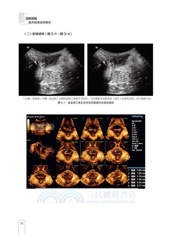 盆底疾病超聲疑難病例解析（簡體書）