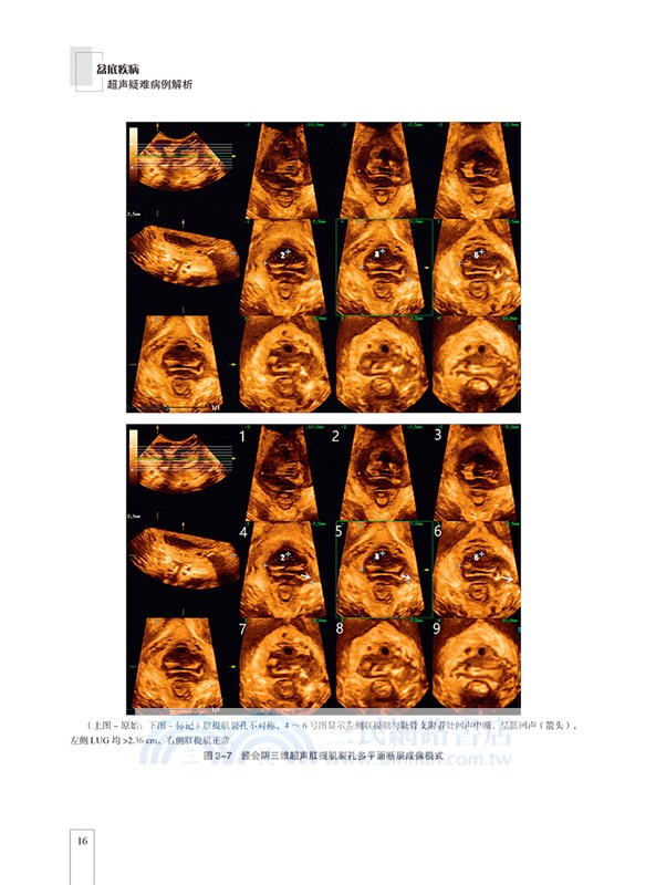 盆底疾病超聲疑難病例解析（簡體書）